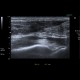 rupture of Achilles tendon: US - Ultrasound